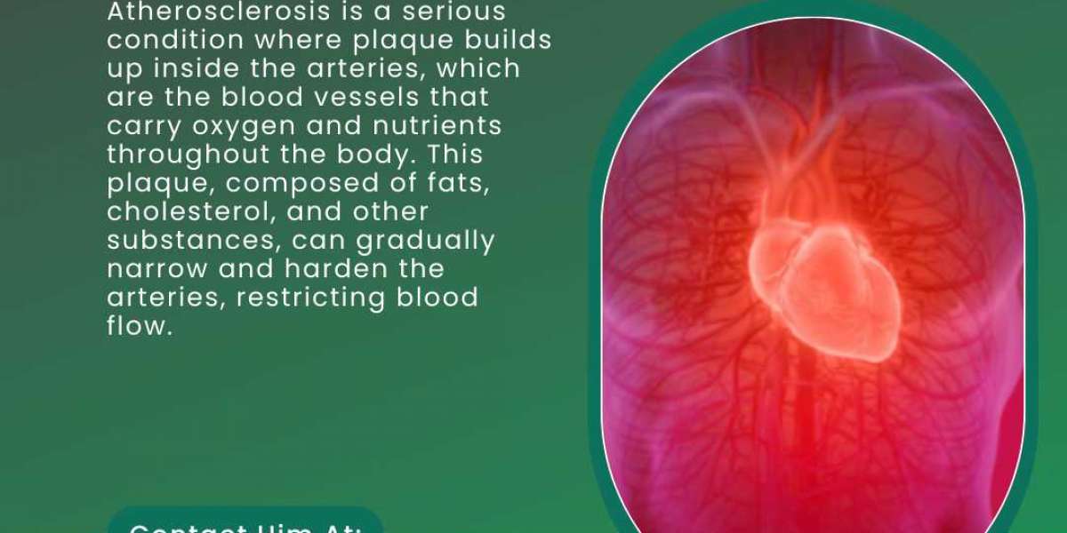 Understanding Atherosclerosis: Insights from the Best Heart Specialist in Ranchi, Dr. Md. Farhan Shikoh