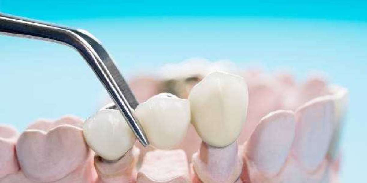 Understanding Dental Bridges: A Comprehensive Guide to Restoring Your Smile