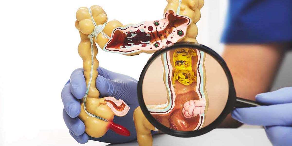 Colorectal Cancer Drug Pipeline Analysis