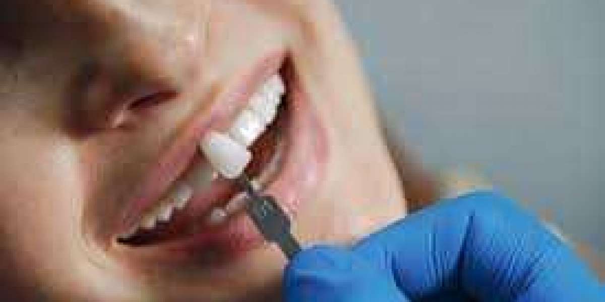 Veneers in Floresville, TX: The Ultimate Guide to a Perfect Smile