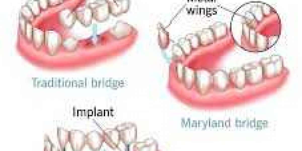 Dental Bridges in Portland, TX: Restoring Smiles with Confidence