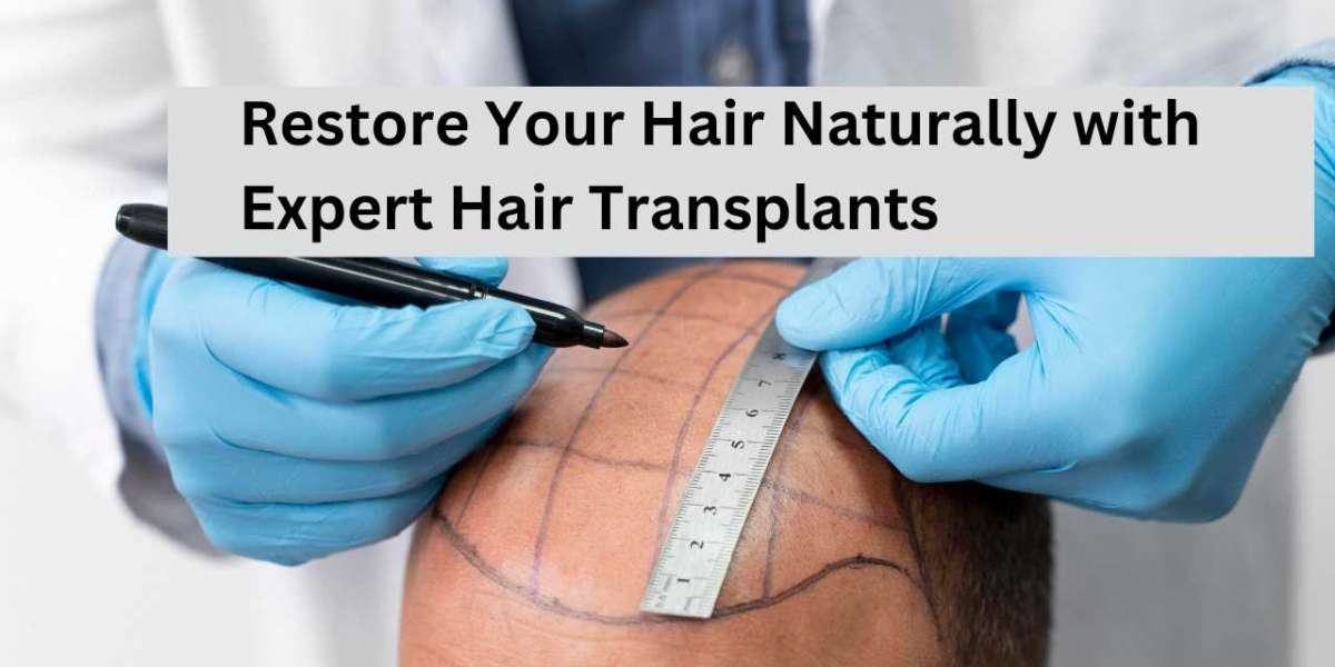 Restore Your Hair Naturally with Expert Hair Transplants