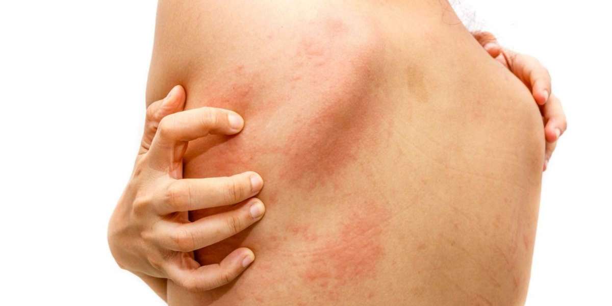 Bacterial infections - symptoms, causes and treatments