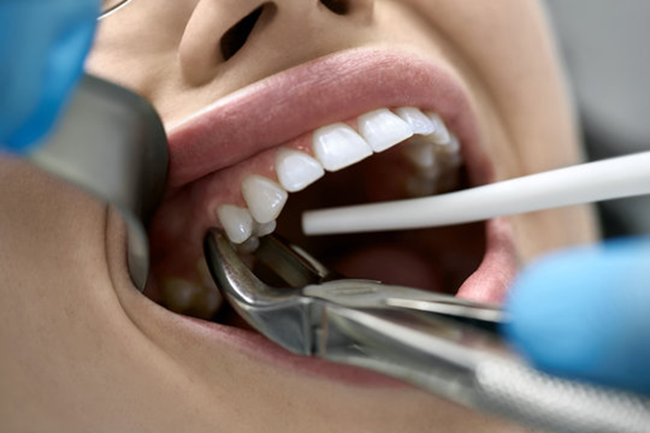 Emergency Tooth Extraction in Abu Dhabi: Where to Go & What to Expect