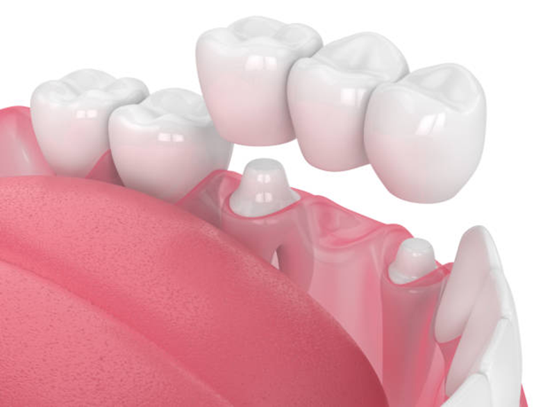 Everything You Need to Know About Getting Dental Crowns in Al Ain