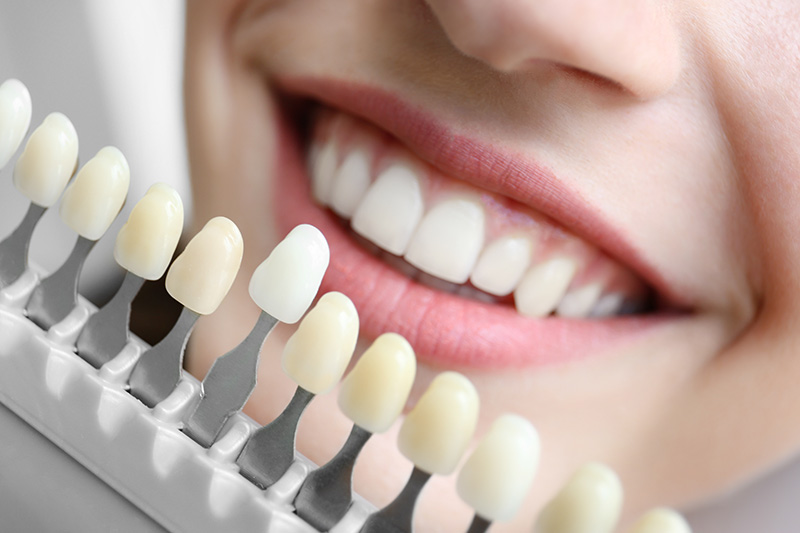 Why Veneers in Fairfax Are the Go-To Solution for a Picture-Perfect Smile - Press Release Submission Sites Free, Free Instant Approval Guest Posting Sites