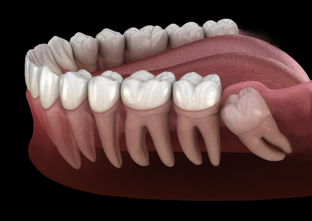 Wisdom Teeth Removal in Roswell: FAQs and Tips - Press Release Submission Sites Free, Free Instant Approval Guest Posting Sites