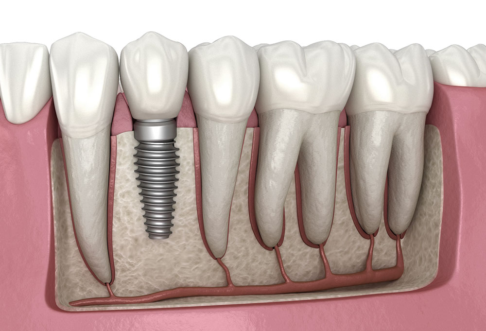 5 Ways Dental Implants Can Improve Oral Health & General Well-Being - Press Release Submission Sites Free, Free Instant Approval Guest Posting Sites