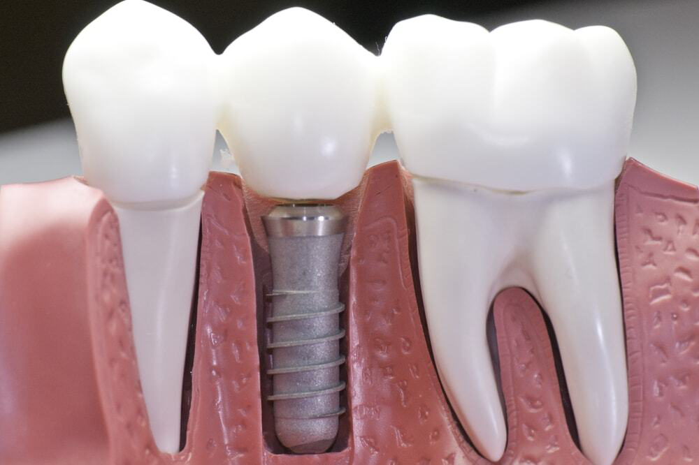 Your Guide to Getting Dental Implants in Gardena - Press Release Submission Sites Free, Free Instant Approval Guest Posting Sites