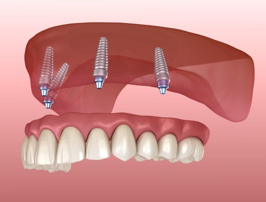 Blogs - Bang Box online - Why Encino Dental Implants Are the Ideal Choice for Tooth Replacement