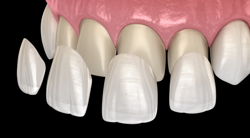 Blogs - Bang Box online - How Veneers in Louisville Can Instantly Upgrade Your Smile