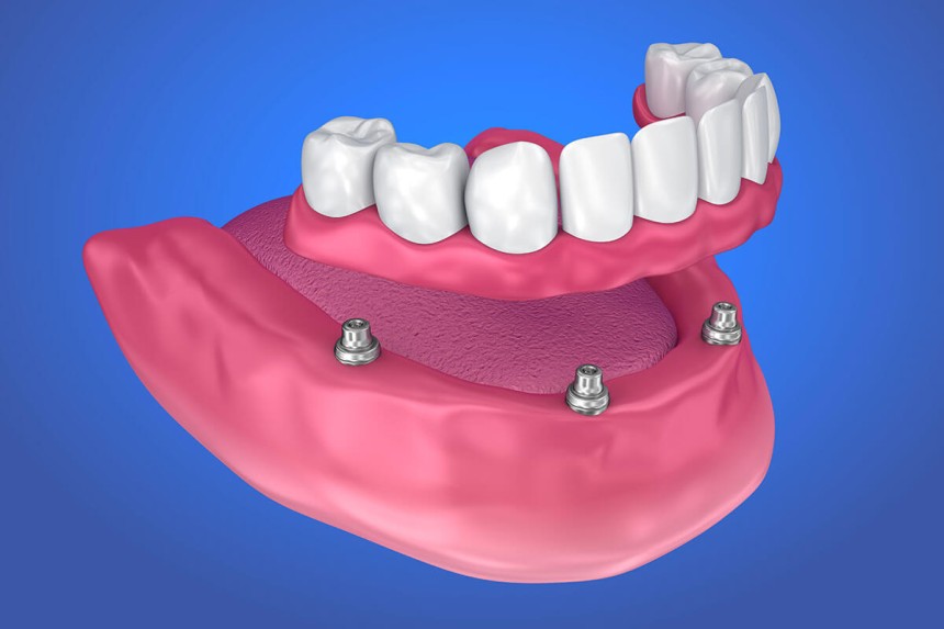 Blogs - Bang Box online - Why More Residents Choose Implant Dentures in Jeffersontown