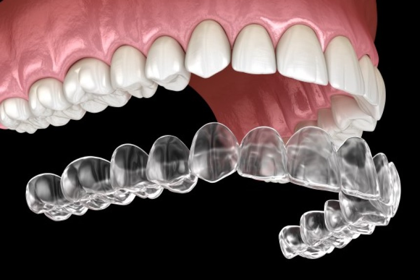 Blogs - Bang Box online - Invisalign in Eminence: The Clear Choice for Teens and Adults