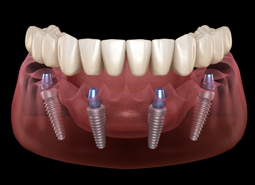 Blogs - Bang Box online - Smile with Confidence: The Complete Guide to All-on Dental Implants in Gardena