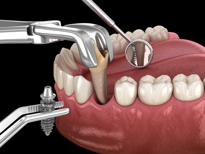 Blogs - Bang Box online - Do You Need Wisdom Teeth Extractions in Playa del Rey?