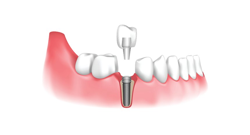 Blogs - Bang Box online - Finding the Right Implant Dentist in Tigard: What to Look For