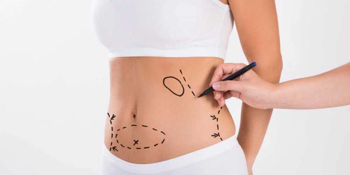 Understanding Liposuction Expert Insight By Best Liposuction Surgeons in Dubai