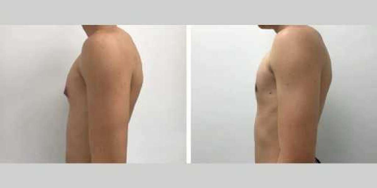 How Gynecomastia Surgery in Dubai Helped Me Regain Confidence