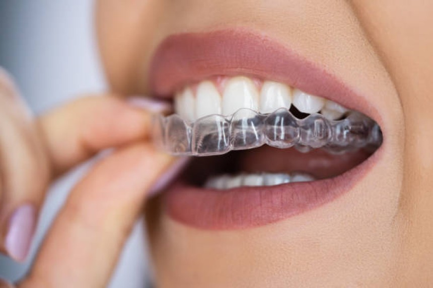 Blogs - Bang Box online - Achieve a Confident Smile with Invisalign in Roseville