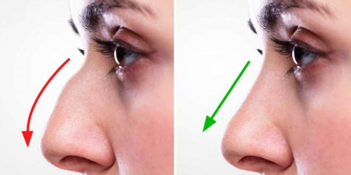 Expert Tips to Choose the Best Rhinoplasty in Islamabad