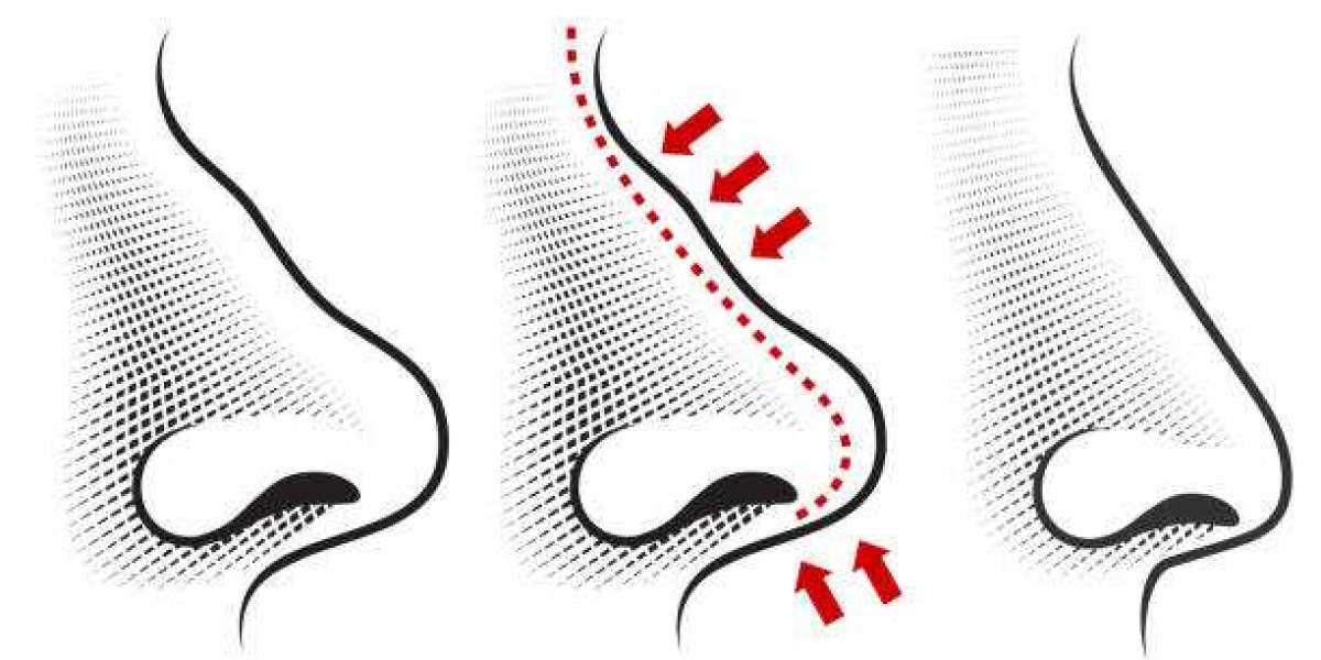 Affordable and Expert Rhinoplasty in Islamabad, Pakistan