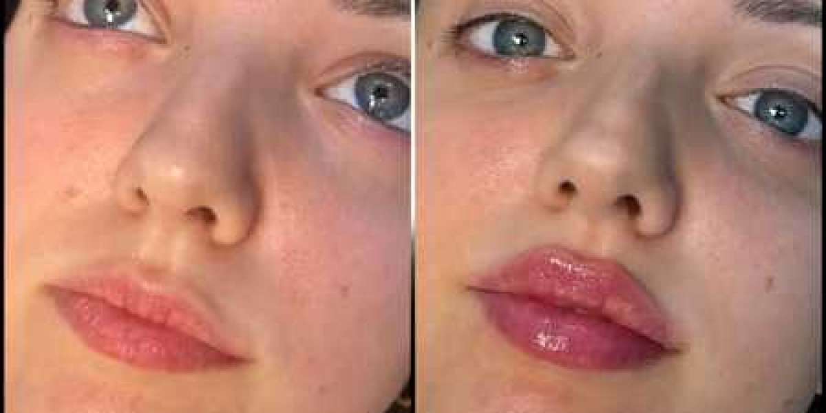 Best Doctors in dubai for Fillers FAQs and Answers
