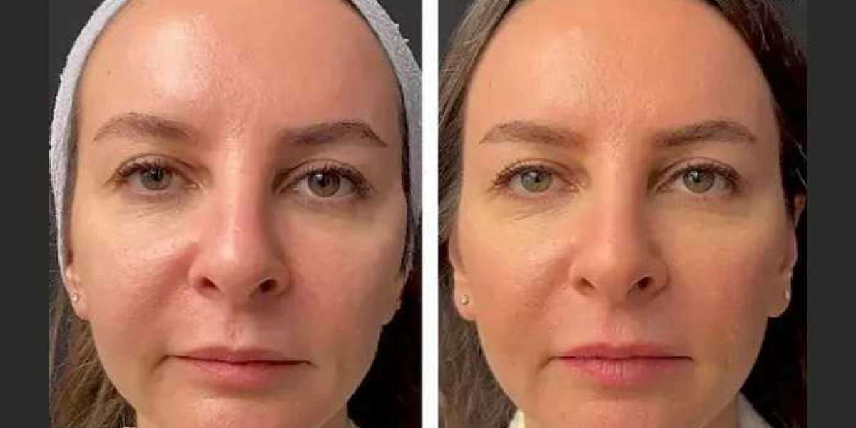 Top Clinics Offering Mesotherapy Treatment in Dubai: A Comprehensive Review