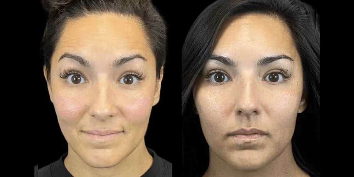 How the Best Doctors in dubai Use Botox for More Than Just Wrinkles