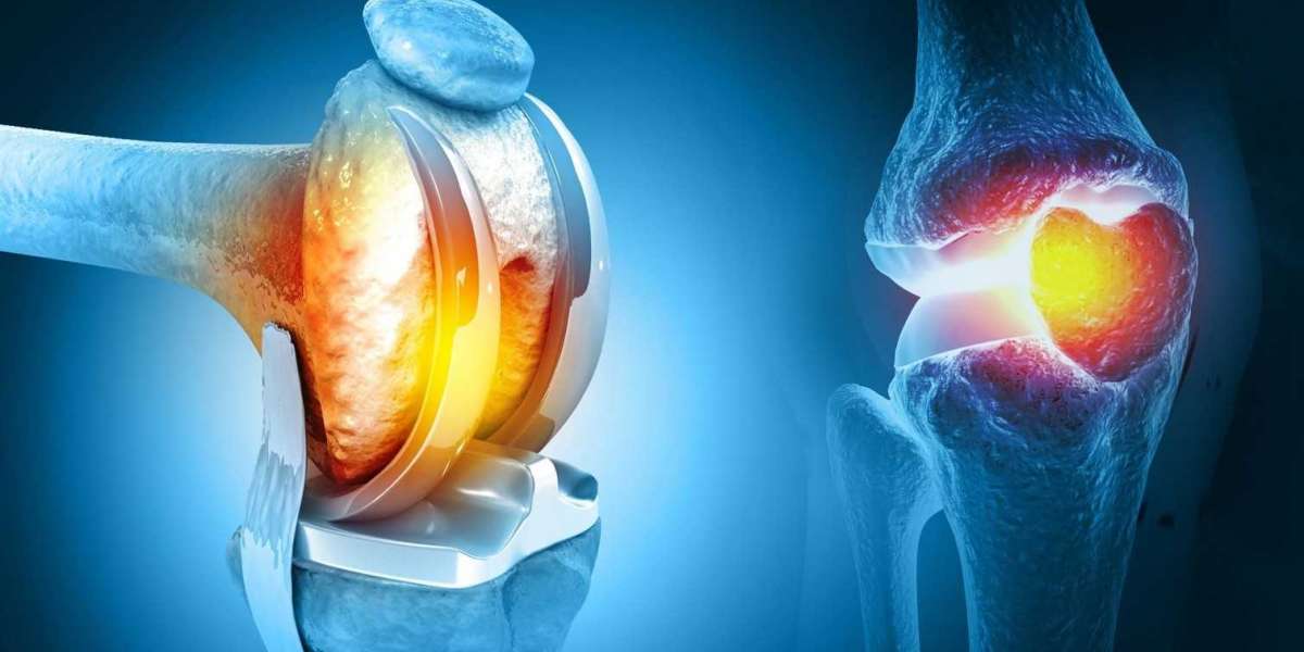 Total Knee Replacement in Islamabad: A New Start for Pain-Free Living