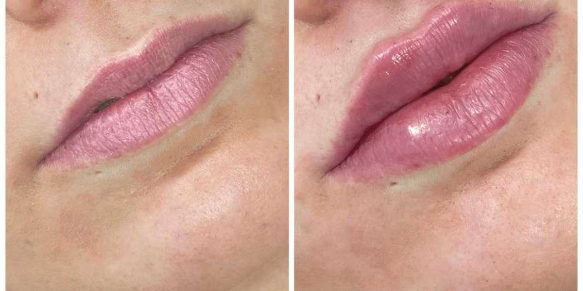 Dermal Fillers for Chin Augmentation: A Look at the Results from the Best Plastic Surgeons in Dubai