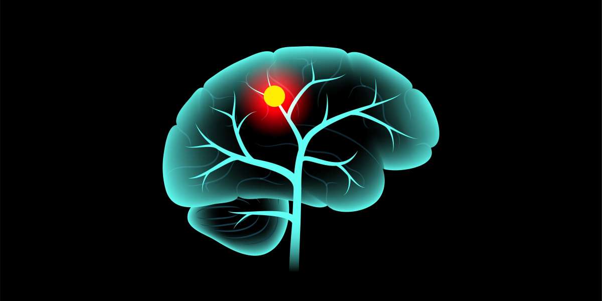 High-grade Glioma Market