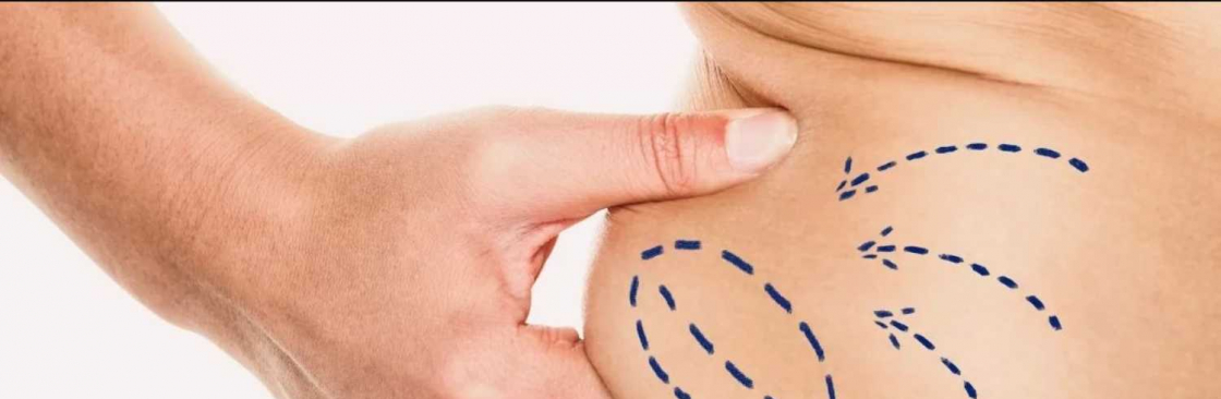 Liposuction Surgery Cover Image