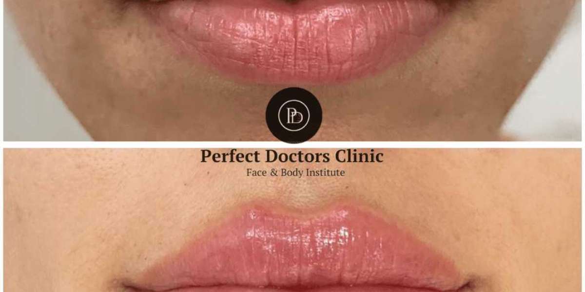 How Juvederm Filler Can Enhance Your Jawline: A Guide from the Best Plastic Surgeons in Dubai