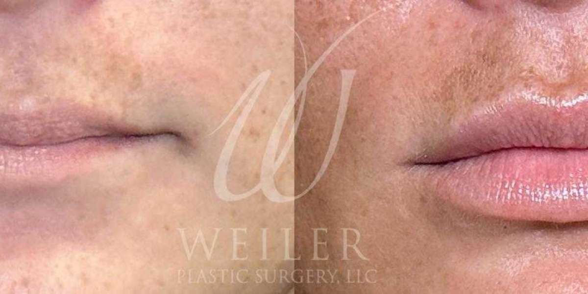 What to Avoid Before and After Injectable Treatments