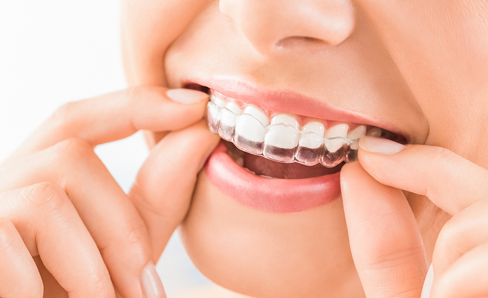 Transform Your Smile with Invisalign in St. Matthews – BDnews55.com