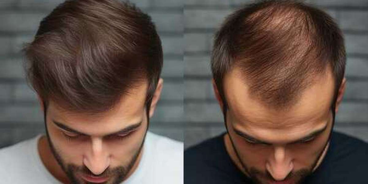 Hair Loss Treatment in Jeddah: Advanced Solutions for Stronger, Thicker Hair