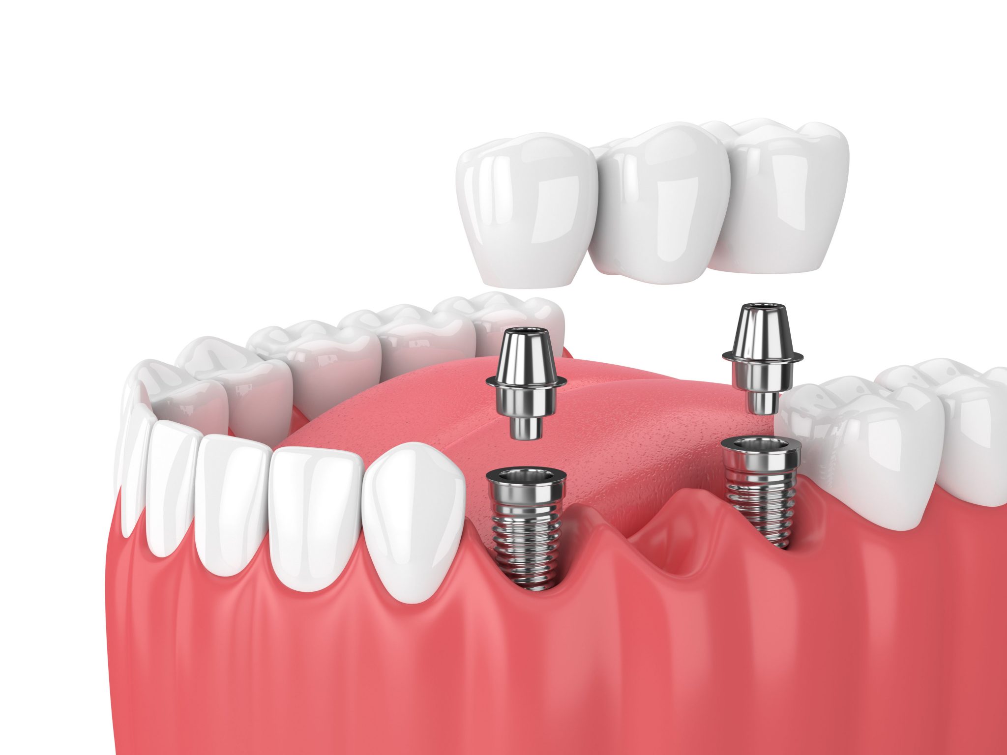 Restore Your Smile with Dental Implants and Implant Dentures – BDnews55.com